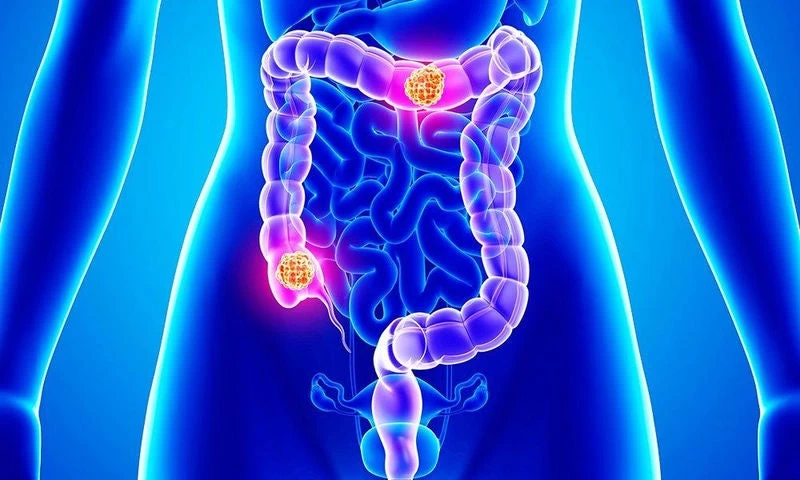 Καρκίνος Παχέος Εντέρου: Ποιος είναι ο μεγαλύτερος «ένοχος» για την πρόκλησή του